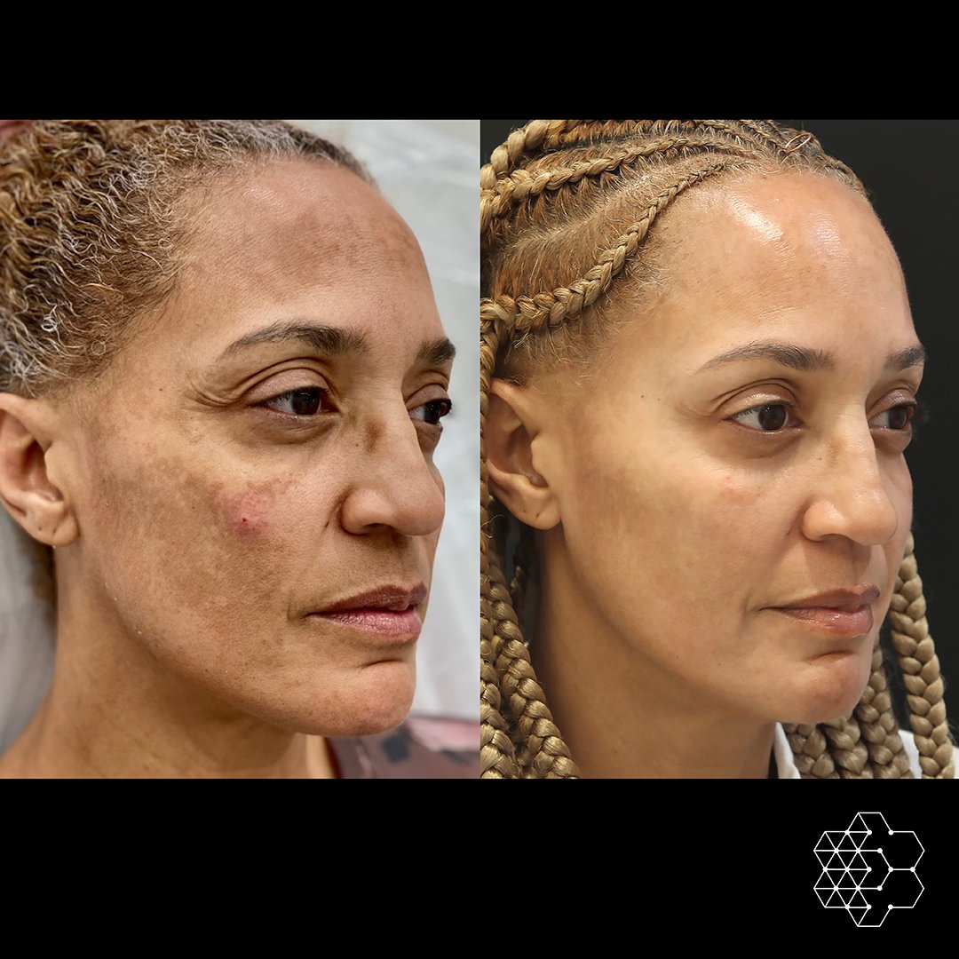 Melasma-July2022-2-2