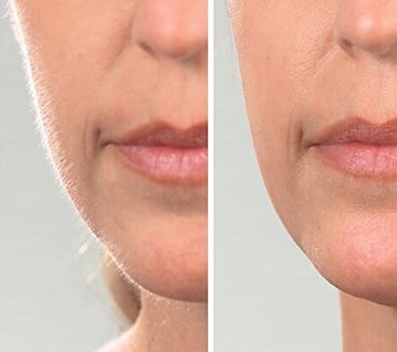 dermaplaningbeforeandafter_copy dermaplaningbeforeandafter_copy